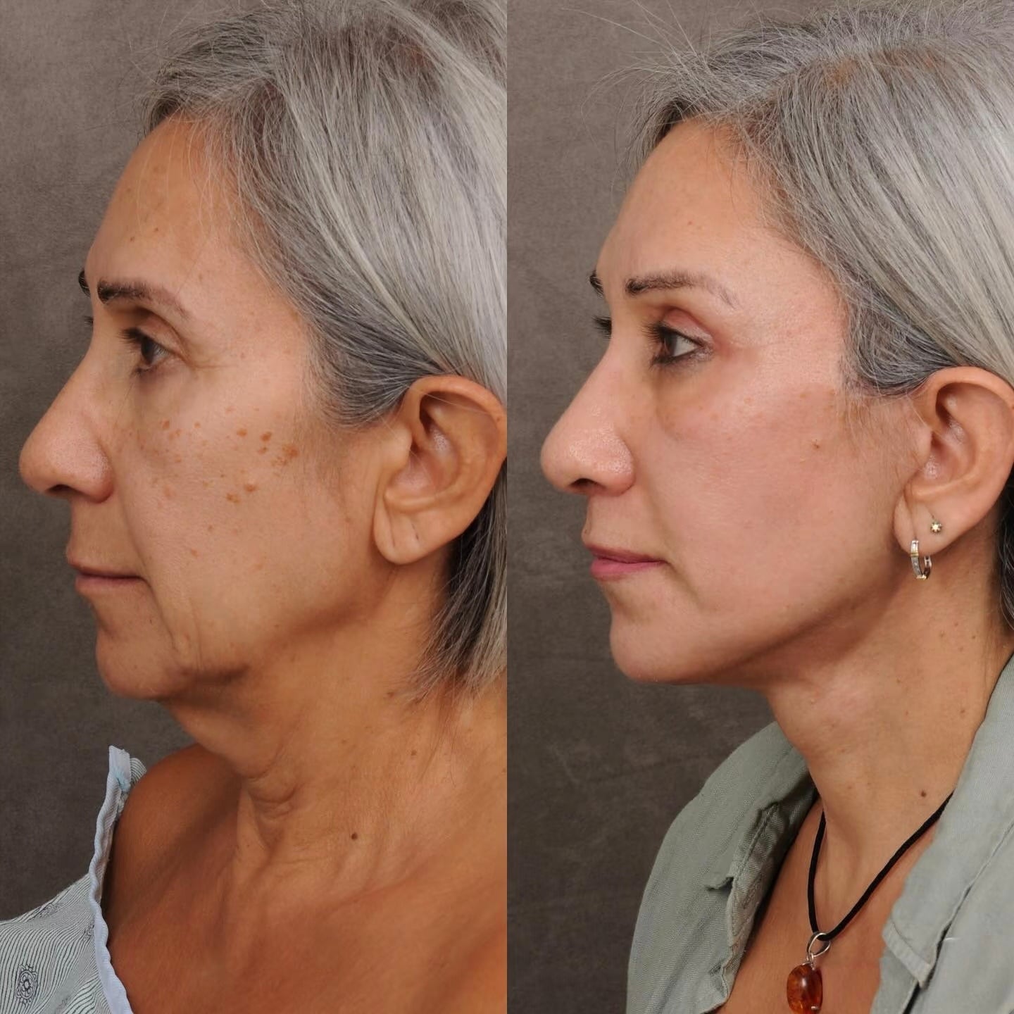 Roller Massage Neck Cream 🧴 Collagen & Hyaluronic Acid | Firms Neck, Reduces Wrinkles & Double Chin